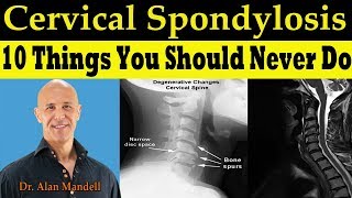 CERVICAL SPONDYLOSIS 10 Things You Should Never Do  Dr Alan Mandell DC [upl. by Fanning]