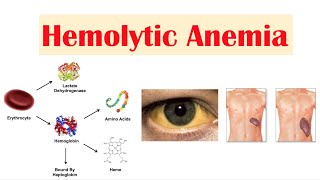 Hemolytic Anemia [upl. by Lladnek]