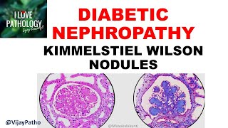 DIABETIC NEPHROPATHY Pathophysiology amp Morphology [upl. by Akimad]