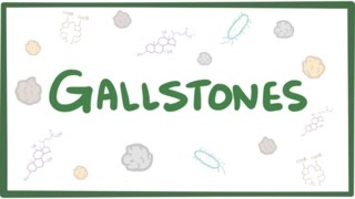 Gallstones cholelithiasis [upl. by Ignatius]