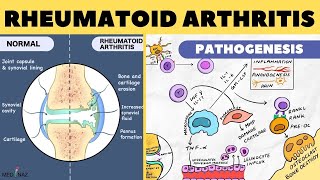 Rheumatoid Arthritis Mode of Action Animation [upl. by Jany]