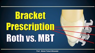 Using Roth and MBT brackets [upl. by Esnahc]