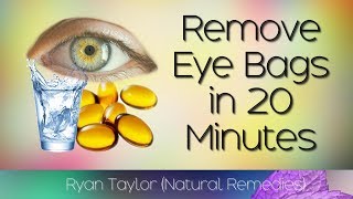 How To Remove Eye Bags 20 Minute Natural Remedies [upl. by Quick]