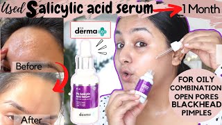 What happened after Using 2 SALICYLIC ACID for 1 Month on OILYCOMBINATION SKIN How amp when to use [upl. by Enileuqaj]